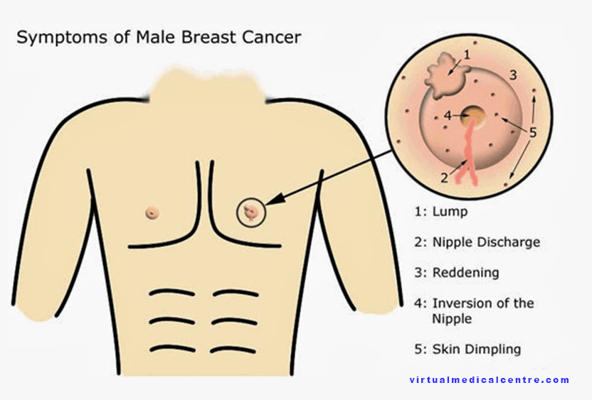 Breast cancer symptons